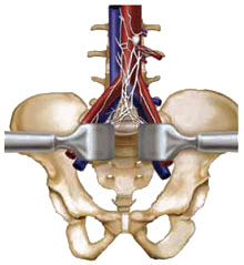 Anterior Lumbar Interbody Fusion