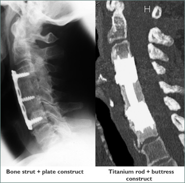 Anterior Cervical Corpectomy-Fusion