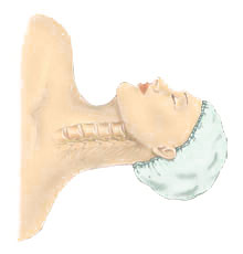 Anterior Cervical Discectomy with Fusion