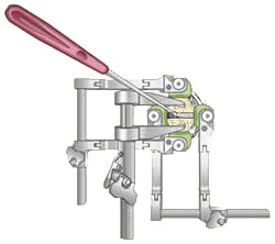 Anterior Cervical Discectomy with Fusion