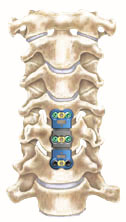 Anterior Cervical Discectomy with Fusion