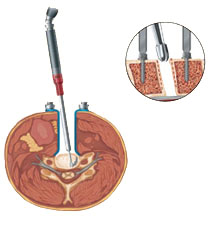 Cervical Artificial Disc