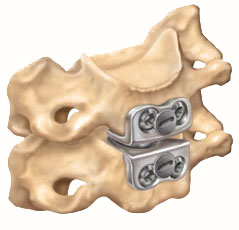 Cervical artificial disc