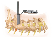 Foraminotomy