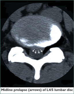 lumbar microdiscectomy