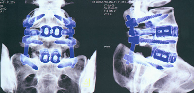 Posterior Lumbar Interbody Fusion