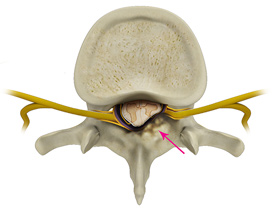 Stenosis